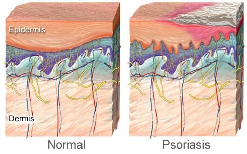 Ayurvedic Treatment for Psoriasis in Kerala  at Vaidya Health Care