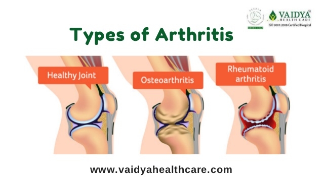 80 - Arthritis with Ayurvedic Treatment in Kochi at Vaidya Health Care