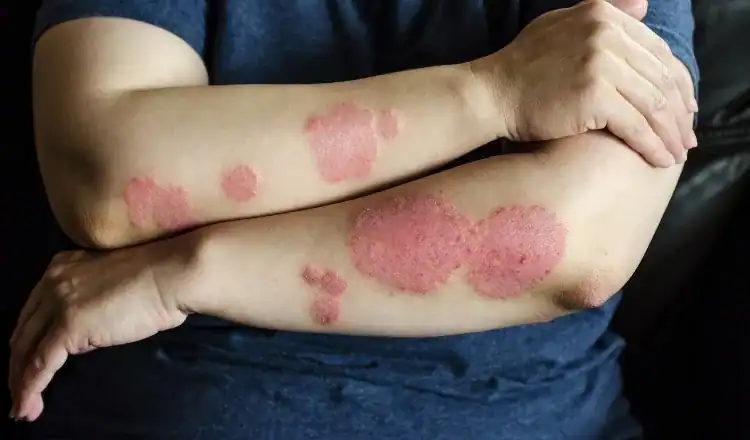 Home Remedies for Psoriasis: Safe or Harmful?